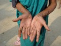 West Bengal, Arsenic Lesion 