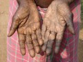 West Bengal, India: Arsenic Lesion